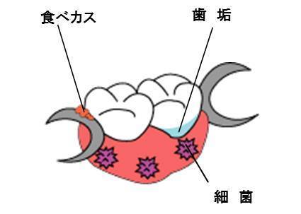 部分義歯の汚れ