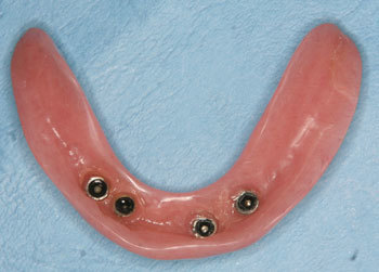 下顎の総義歯にハウジングを4本埋め込む