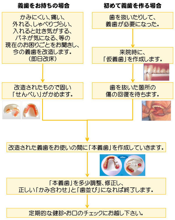 カマタ歯科クリニックの精密義歯の作り方(制作方法の一例)