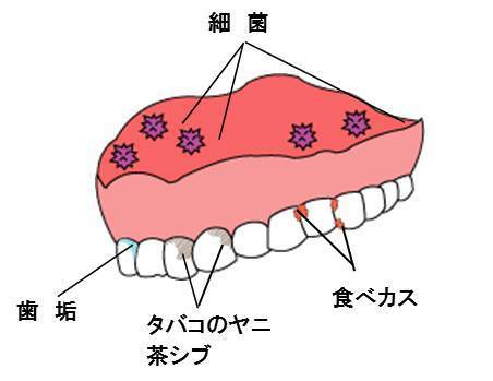総義歯の汚れ