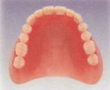 精密レジン床義歯
